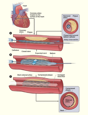 Stent placement.gif