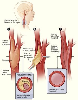 Cad endarterectomy.jpg